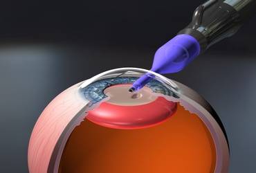 Гипотензивного эффекта факоэмульсификации катаракты