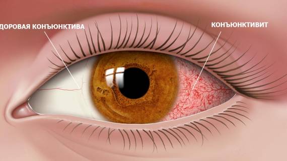 Лечение конъюнктивита глаза в Крыму в «ОКО Центр»