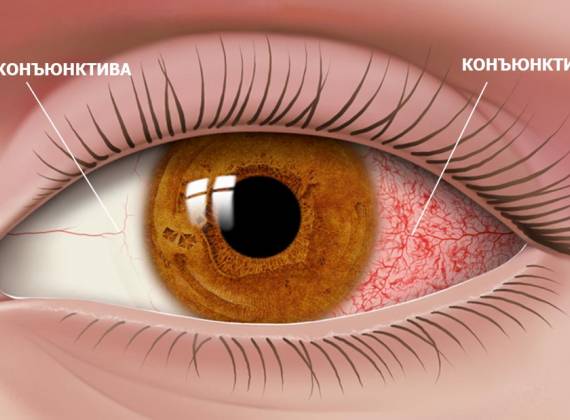 Лечение конъюнктивита глаза - "Око-центр", Симферополь
